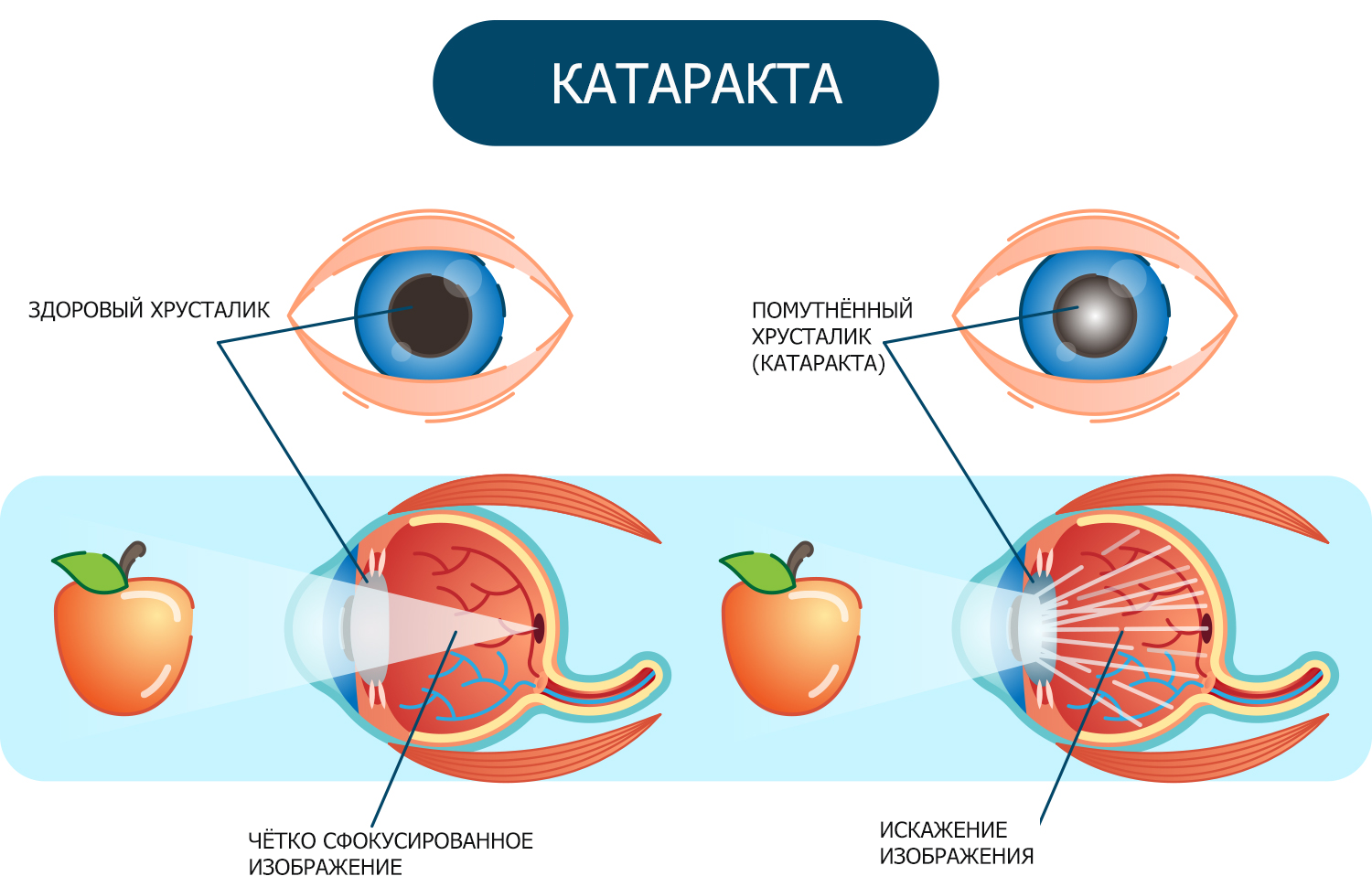 Катаракта: причины, симптомы, диагностика и лечение.