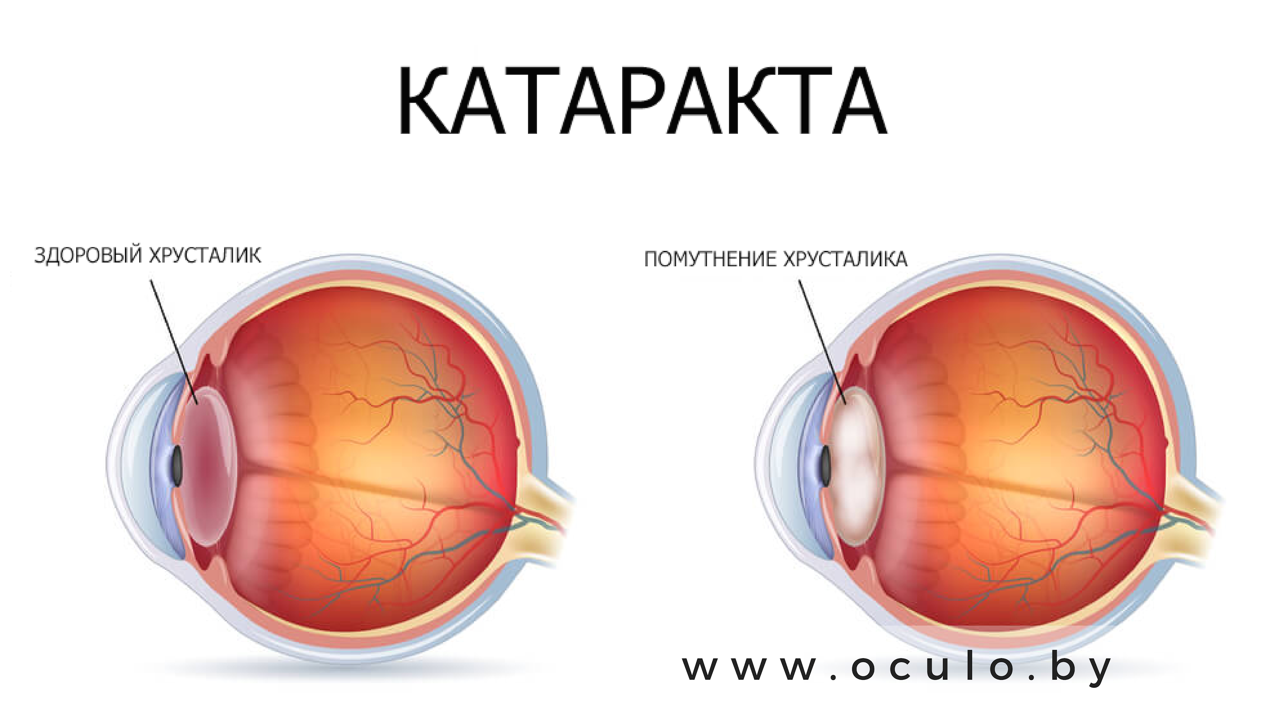 Катаракта: причины, симптомы, диагностика и лечение.